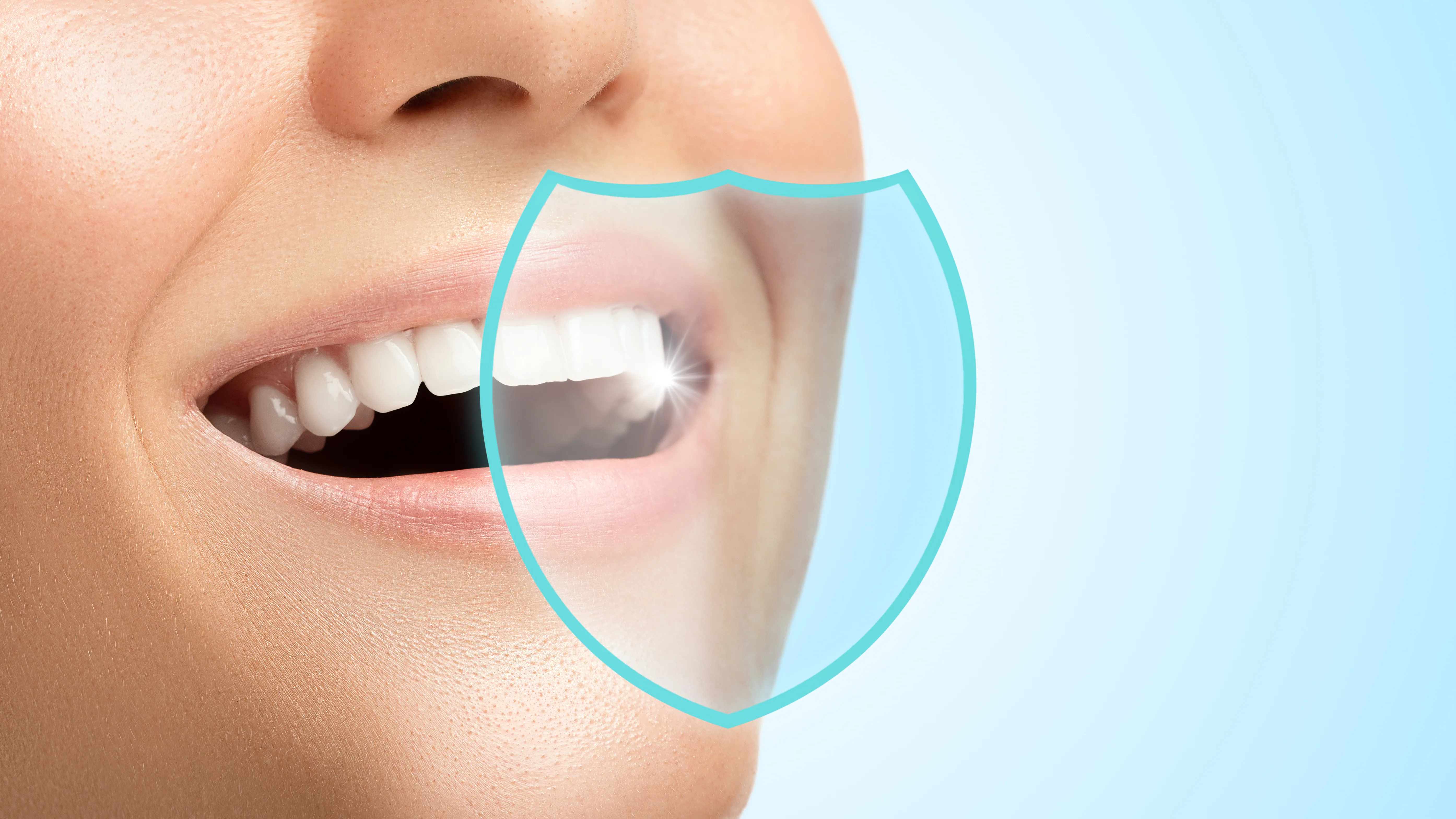 Tooth-colored fillings