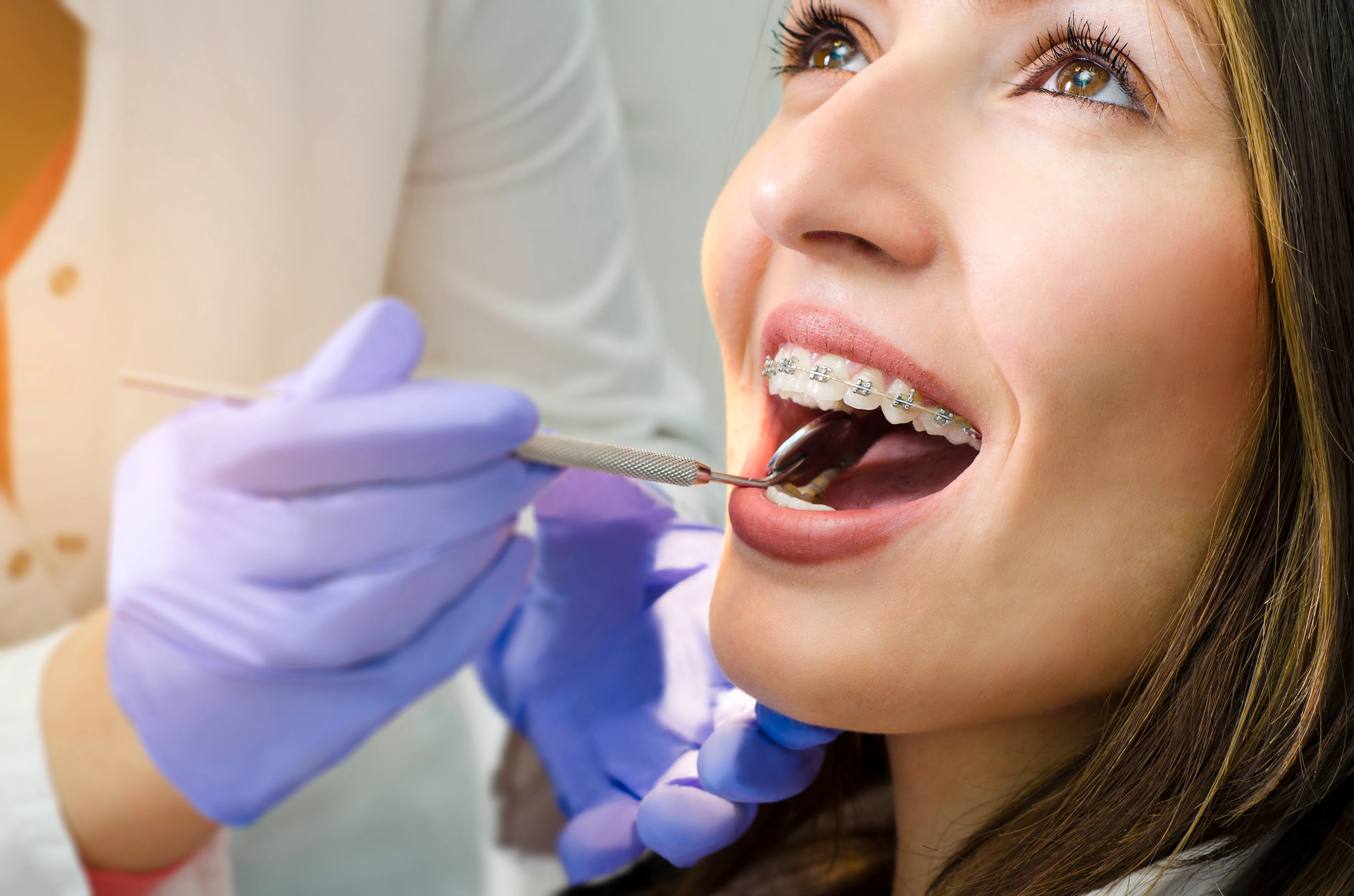 Clear aligners