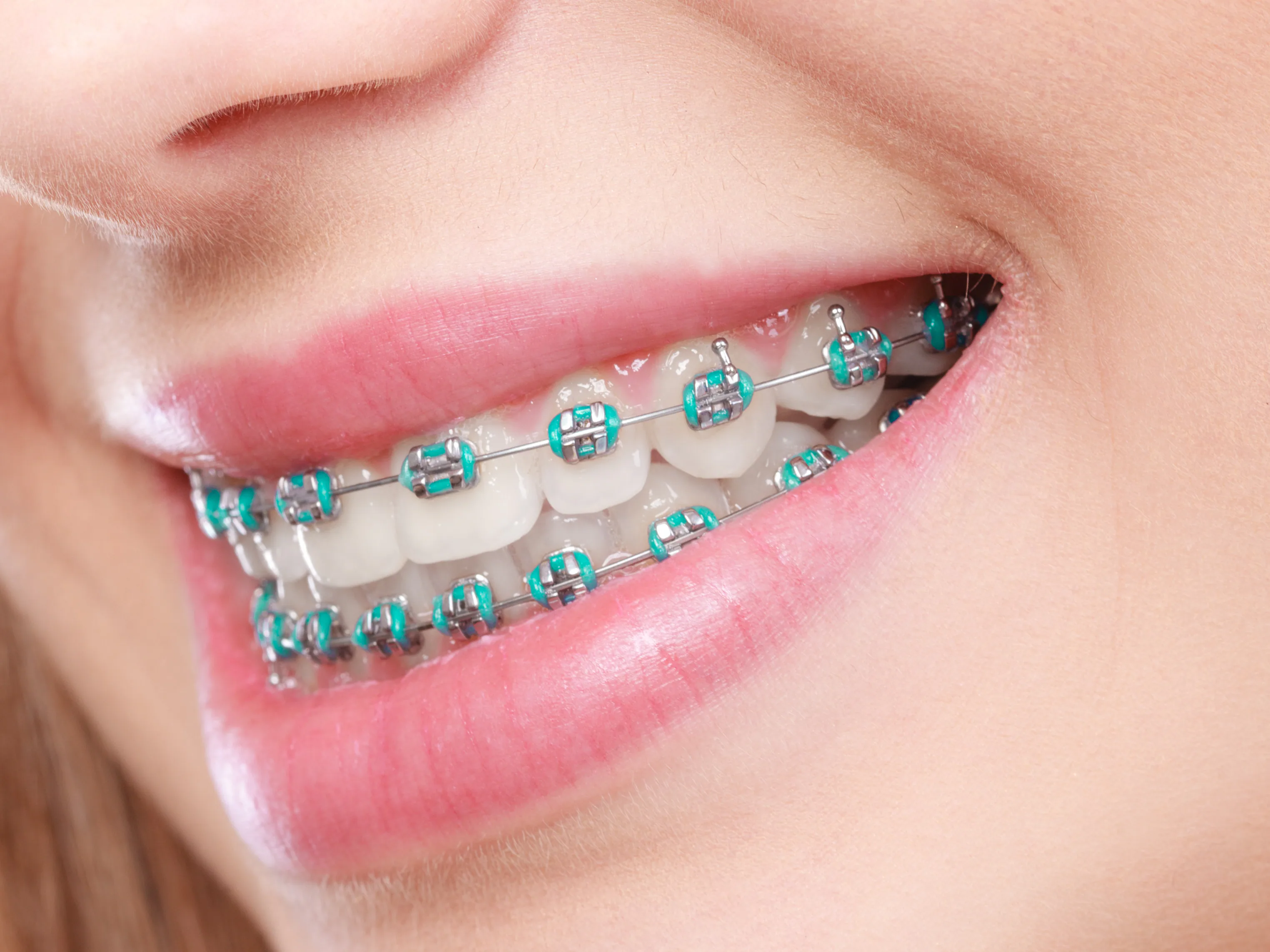 Clear aligner held beside a smiling patient